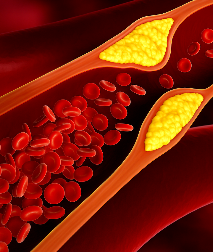 Orales Mikrobiom triggert Atherosklerose